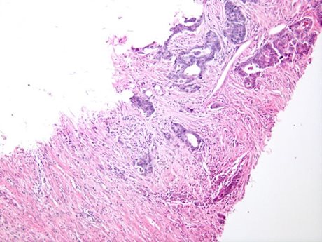 Human Intestine Cancer HS0006