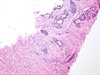 Human Intestine Cancer HS0006